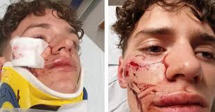 Allochtonen slaan Lennert (15) in elkaar  op fuif in Kalmthout