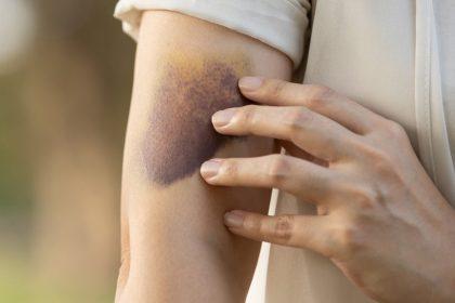 Huiselijk geweld: “Franse en Spaanse aanpak verdient navolging”